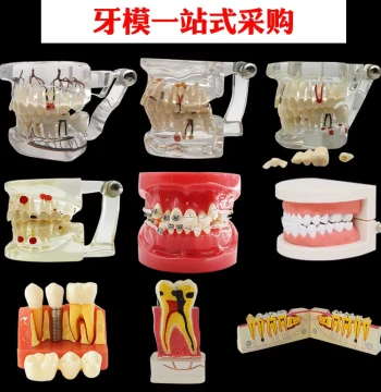 Standard Dental Model for Implantology, Removable Nerve Tooth Mold, Full Arch Prosthesis Pathology Model for Doctor-Patient Communication