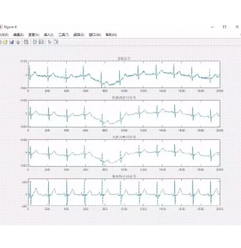 MATLAB Program for ECG Signal Denoising Using Low-Pass Filtering and Wavelet Decomposition