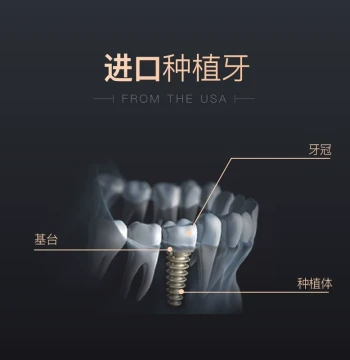 Dental Implant Package - Full Mouth Zirconia Crowns by Dilic for Missing Teeth Replacement